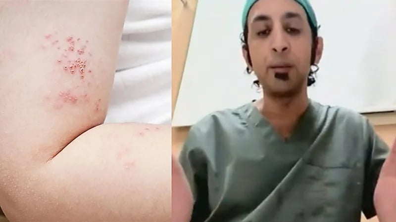 استشاري: النساء أكثر عرضة للإصابة بـ "الحزام الناري"