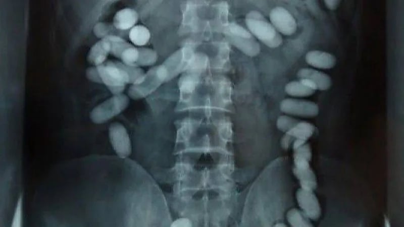 السجن 10 سنوات لآسيوي هرب مخدرات داخل أحشائه