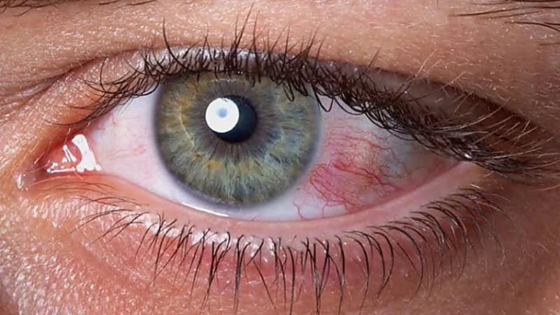 أخصائي بصريات يوضح أسباب جفاف العيون وأعراضه المزعجة