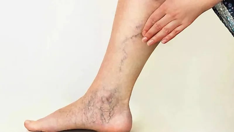 برودة الأطراف قد تكون إنذارًا مبكرًا للإصابة بالدوالي