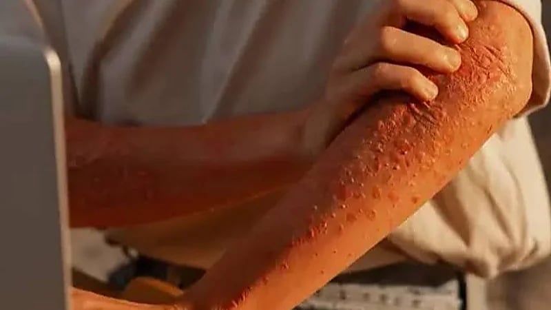 5 عوامل قد تسبب نشاط الفيروس الخامل في الجسم .. فيديو