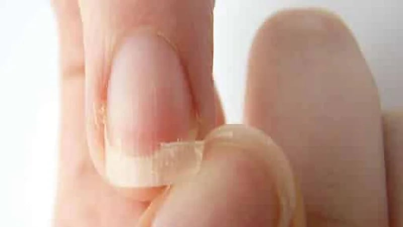 علامات نقص الحديد بالجسم