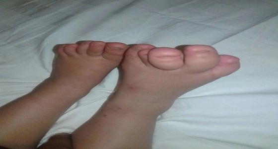 تعاني من عيب خلقي بقدميها.. مواطن يناشد خادم الحرمين علاج ابنته