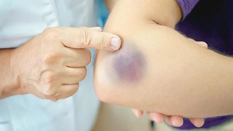 البقع الزرقاء على الجسم من أعراض أمراض الكبد