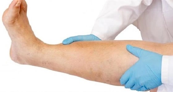 " النمر " يوضح مضاعفات جلطة الساق