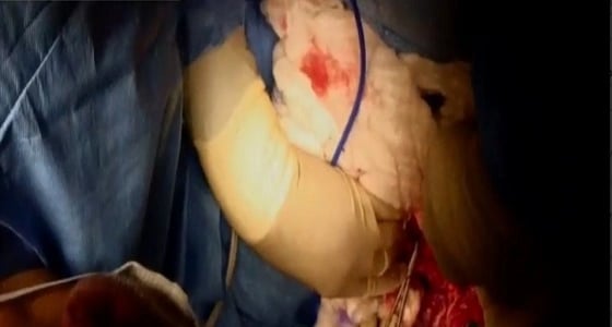 عملية فصل التوأم السيامي الفلسطيني تدخل مرحلة فصل الطرف السفلي المشترك