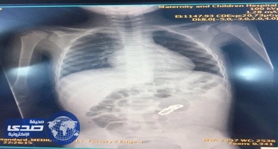 إستخراج قطعا معدنية من بطن طفل في جدة