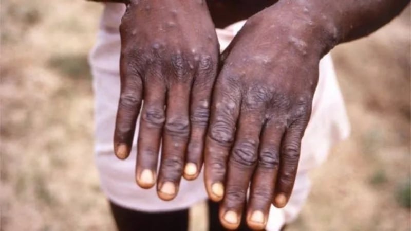 الصحة العالمية: لا داعي للخوف من تحول جدري القرود لجائحة