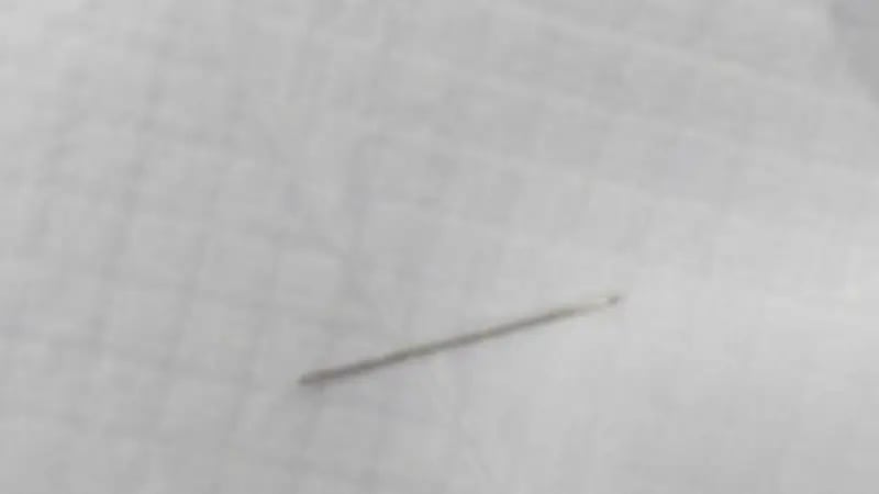 "فريق طبي" ينجح باستخراج إبرة خياطة من بطن مريضة بتخصصي بريدة