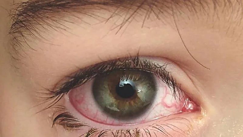 بالفيديو .. طبيب : أحد مسببات مرض "العشى الليلي" هو زواج الأقارب