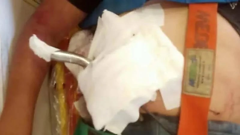 استخراج مقود دراجة من بطن طفل