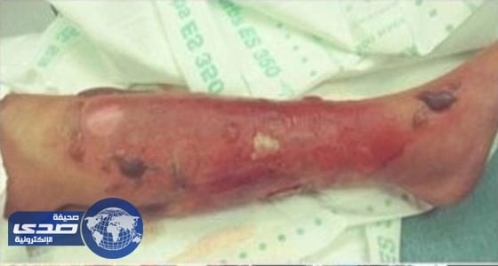 سيدة تُصارع الموت نتيجة بكتيريا قاتلة بالبحر