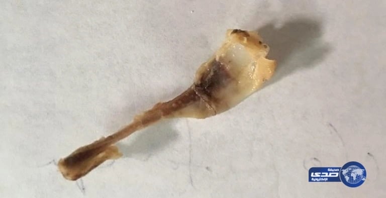 استخراج عظم علق بحلق طفل دون تدخل جراحي في الأفلاج