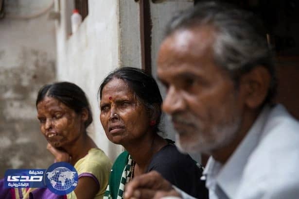 بالفيديو.. هندية وابنتها تعيشان مع رجل هاجمهما بـ " ماء نار " .. والسبب!