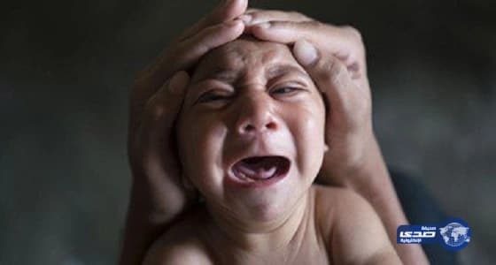 إصابة 49 حامل ب " زيكا" وولادة طفل مشوه فى أمريكا