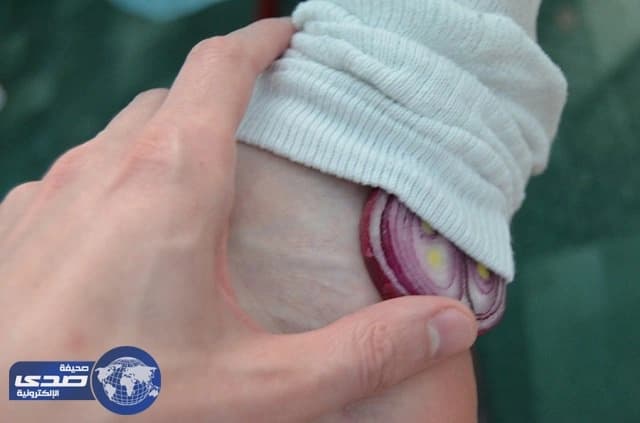 أخصائي : يجب على الصائم أن يلف قدمه بشريحة بصل