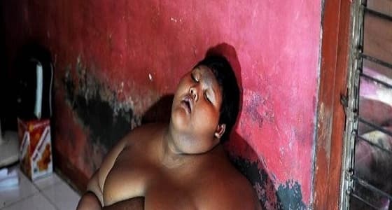 أسمن طفل في العالم يذهل الأطباء بتحوله