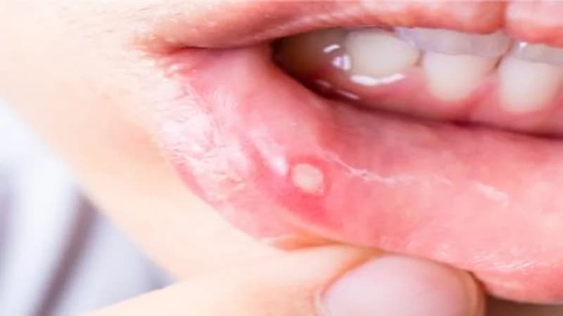 منها خل التفاح والثوم.. علاجات منزلية بسيطة لقرحة الفم