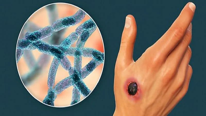 وباء الجمرة الخبيثة يثير الرعب في روسيا