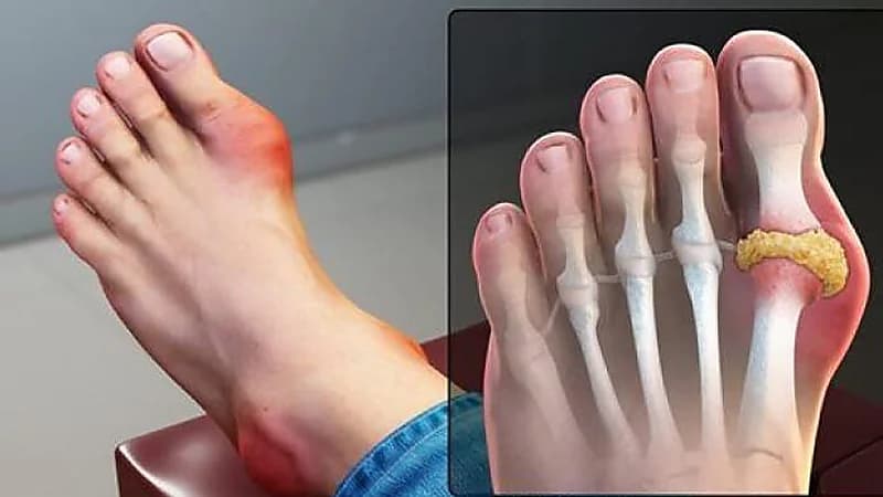 خبراء يكشفون أسباب مرض النقرس