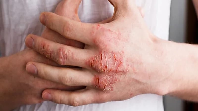 طريقة فعالة تساعد في إيقاف حكة الإكزيما