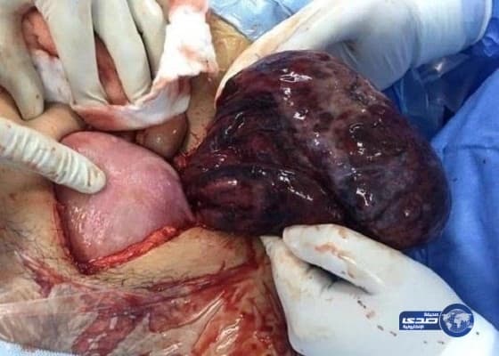 إنجاز طبي رابع خلال شهرين بمستشفي صبيا .. استئصال ورم وزنه ثلاثة كيلو من بطن سيدة