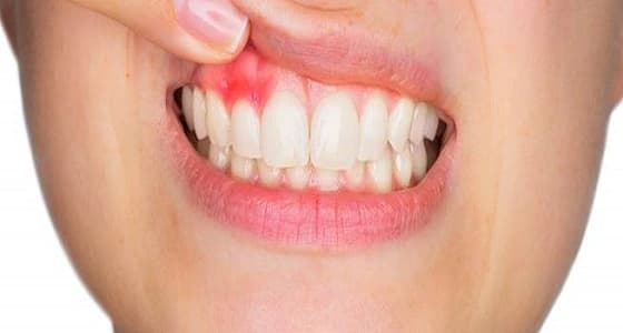 أمراض اللثة تزيد من خطر الإصابة بسرطان القولون بنسبة 80%